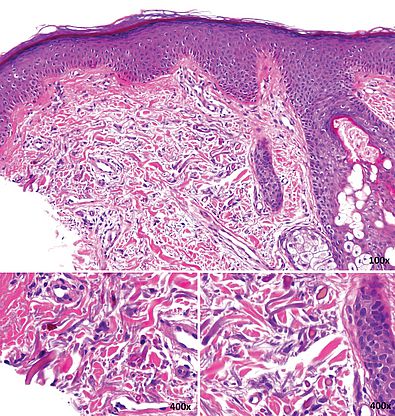 Fibrillen, Dermis