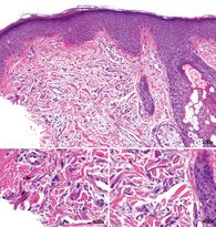 Fibrillen, Dermis