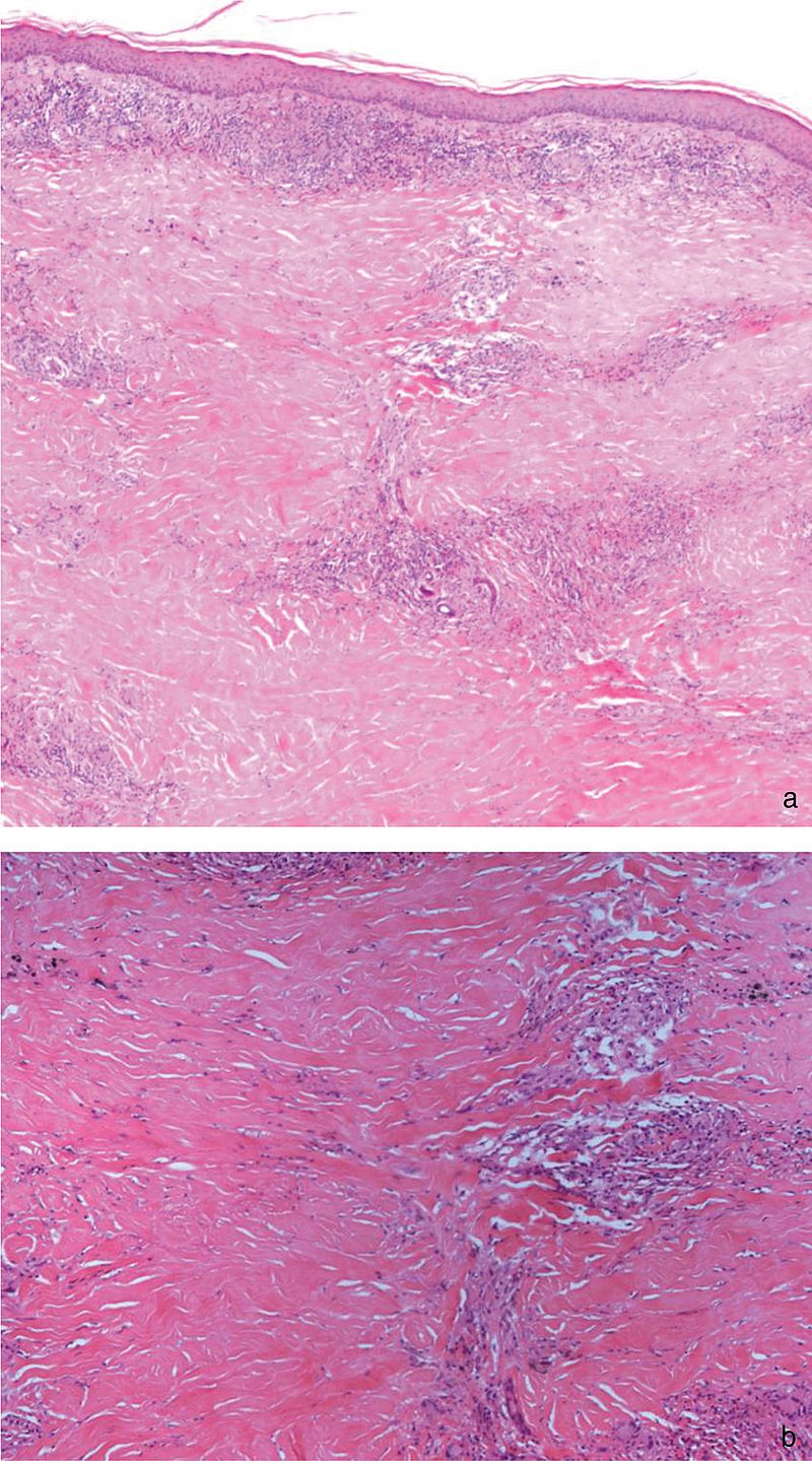 degeneriertes Bindegewebe, Pigmentablagerung