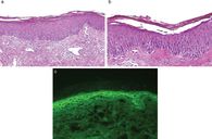 Histopathologischer Befund, akantholytische Zelle, Immunfluoreszenz