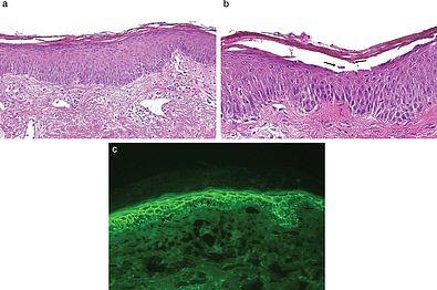 Histopathologischer Befund, akantholytische Zelle, Immunfluoreszenz