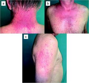 Foto: wachsartige, verhärtete, haut- oder erythematös gefärbte Papeln und Knötchen, die den Nacken (a), die Brust (b) und beide Deltoideusregionen (c) betreffen.