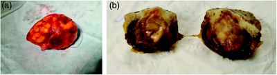 Foto:  Vollständiges Tumorexzidat und (b) das halbierte Tumorexzidat nach Formalinfixierung