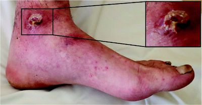 Foto Rechtes Sprunggelenk mit kreisförmiger Ulzeration und Pseudomembran.