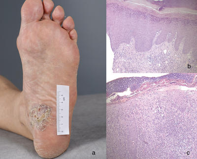 Makroskopisches Bild des Tumors, Fußsohle, Plaque