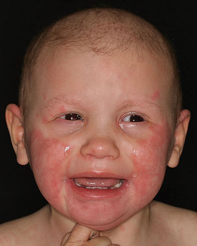 Kleinkind, erosive Plaque, Zink-Therapie
