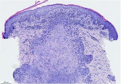 Foto Dermal nekrotisierende Granulome mit vaskulitischen Veränderungen.