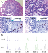 Histomorphologie, Immunhisttochemie, Talgdrüsenkarzinom, Tumor