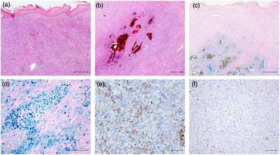 Foto:  Histologie des Exzidates aus dem linken Oberarm