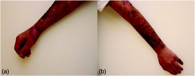 Foto (a, b) Abheilungstendenz der Hautveränderungen nach intravenöser Antibiose mit Ampicillin/Sulbactam