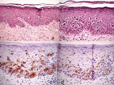 histopathologische Untersuchung, Extramammärer Morbus Paget der Vulva, Epidermis