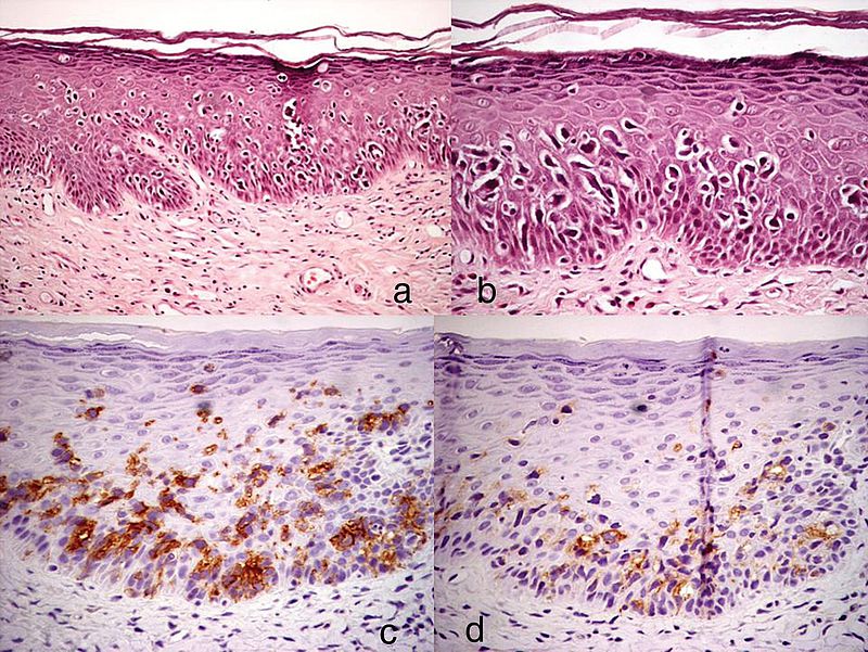 histopathologische Untersuchung, Extramammärer Morbus Paget der Vulva, Epidermis