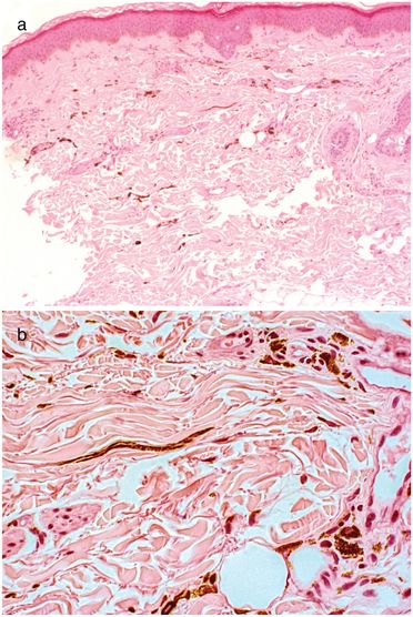 Probebiopsie Stirn, pigmentierte spindelzellige Melanozyten, Stratum reticulare