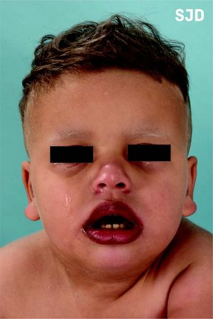 Foto: Kind mit silbriger Pigmentierung der Haare, Augenbrauen und Wimpern mit gebräunter Haut und Pigmentierung der Lippen.
