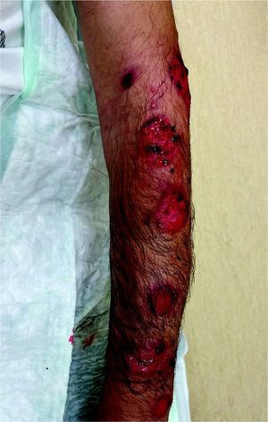 Foto Akral betonte kreisförmige Ulzerationen und Erosionen mit Pseudomembran