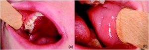 Foto-(a) Gingiva mit Schleimhaut-Pseudopolypen, (b) Ödem der Wangenschleimhaut.