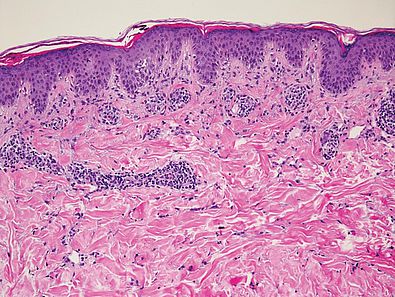 Akanthose, perifollikuläre Hyperkeratosen, lymphohistiozytären Infiltrat