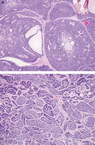 Spiradenom, Tumore, Zellen mit hyperchromatischem Kern