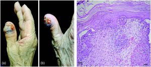 Foto, Histologische Analyse des Tumors (Hämatoxylin-Eosin-Färbung