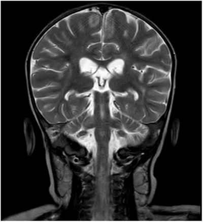Foto: ZNS-MRT mit deutlicher Veränderung des Intensitätssignals der weißen Substanz und allgemeinem Volumenverlust. Kontrastmittelaufnahme des rechten Stirnsinus