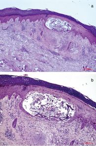 Epidermis, intraepidermalen Hornzyste