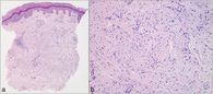 diskretes perivaskuläres lymphozytäres Entzündungsinfiltrat