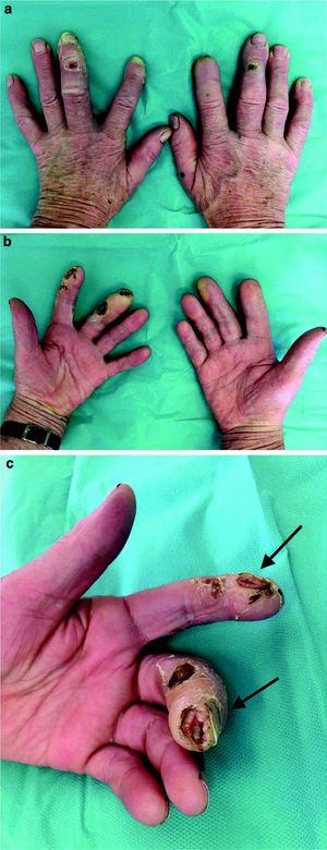 Foto-Symmetrische, nekrotische Läsionen über den distalen Interphalangealgelenken beider Mittelfinger
