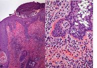 Epidermis, subkorneale Oustelbildung, Granulozyten