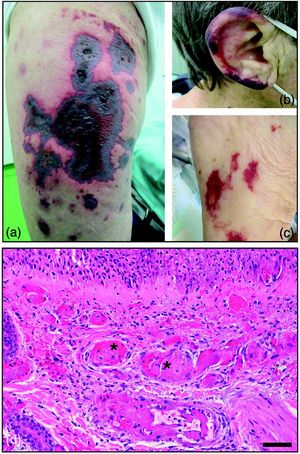 Foto-Nekrotische Purpura an den unteren Extremitäten und (b) Ohrmuscheln. (c) Retiforme purpuriforme Maculae an den Unterschenkeln. (d) Dilatierte und thrombosierte kleine Gefäße