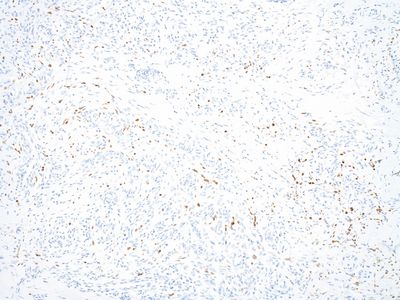 Immunhistochemisch Positivität für Antikörper gegen humanes Herpesvirus Typ 8