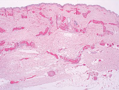 Histologisches Präparat, Thrombosen, Infiltrate