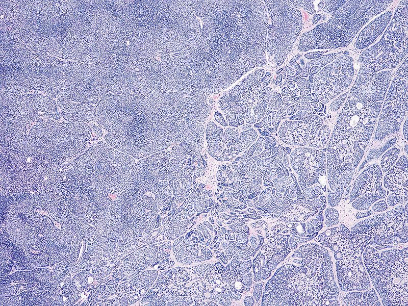 Spiradenozylindrom, basaloide Zellkomplexe, Tumor