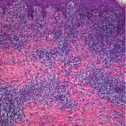 Probebiopsie, koriale Darstellung, Granulom, Riesenzellen