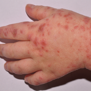 lymphozytäres Infiltrat