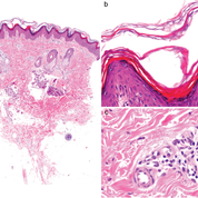 Akanthose, Papillomatose, Orthohyperkeratose, Paraketarose, perivaskuläres lymphohistiozytäres Infiltrat