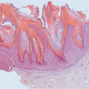 warzenähnlichen Läsion, Papillomatose,  mäßige Hyperakanthose, fokale Hyperkeratose