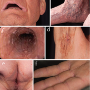 Disseminierte warzen-ähnliche Hautläsionen, Weiße Papeln, Ösophagusschleimhaut, Achselhöhlen, bräunliche Hyperpigmentierung