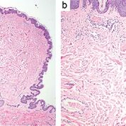 polypoid, Tumor, Faserwerk