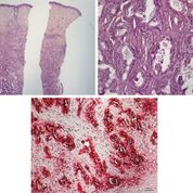 Histopathologischer Befund, Epidermis, Tumorzellen,